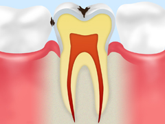 C1：エナメル質の虫歯