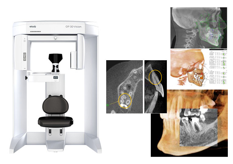 歯科用3DCT