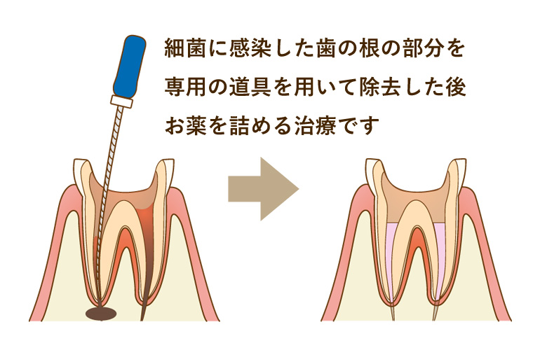 歯根治療