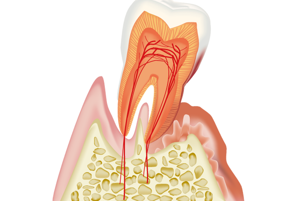 歯周病治療