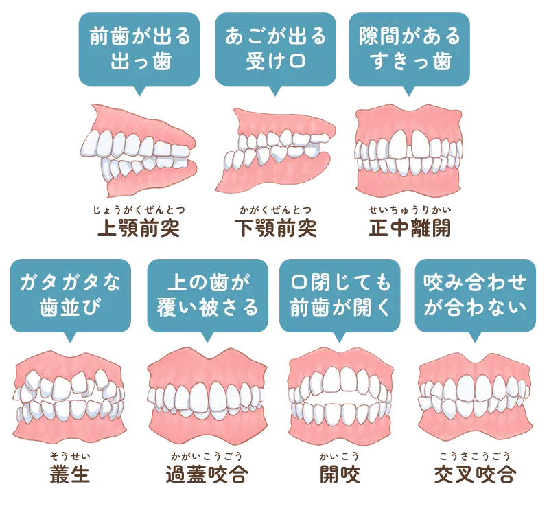 不正咬合
