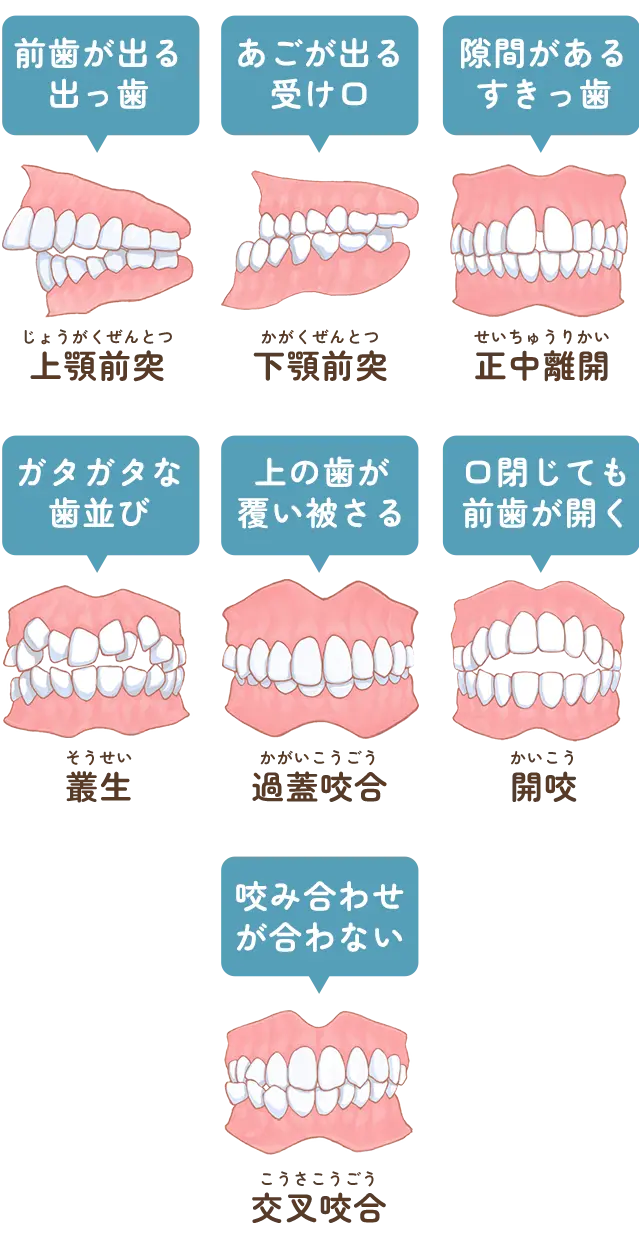 不正咬合