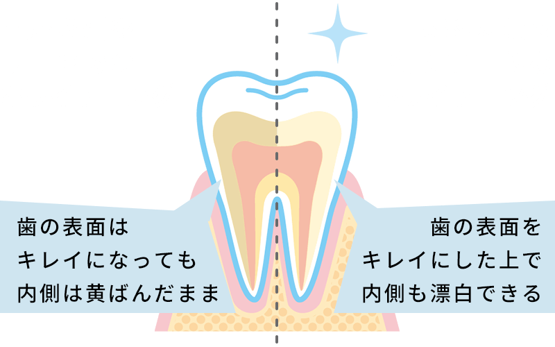 象牙質まで白くする